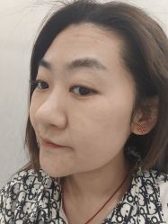 体验后-北京英煌医疗美容
