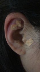 -肥三针腧穴瘦身馆