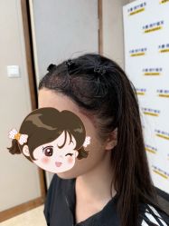 -大麦微针植发全国连锁