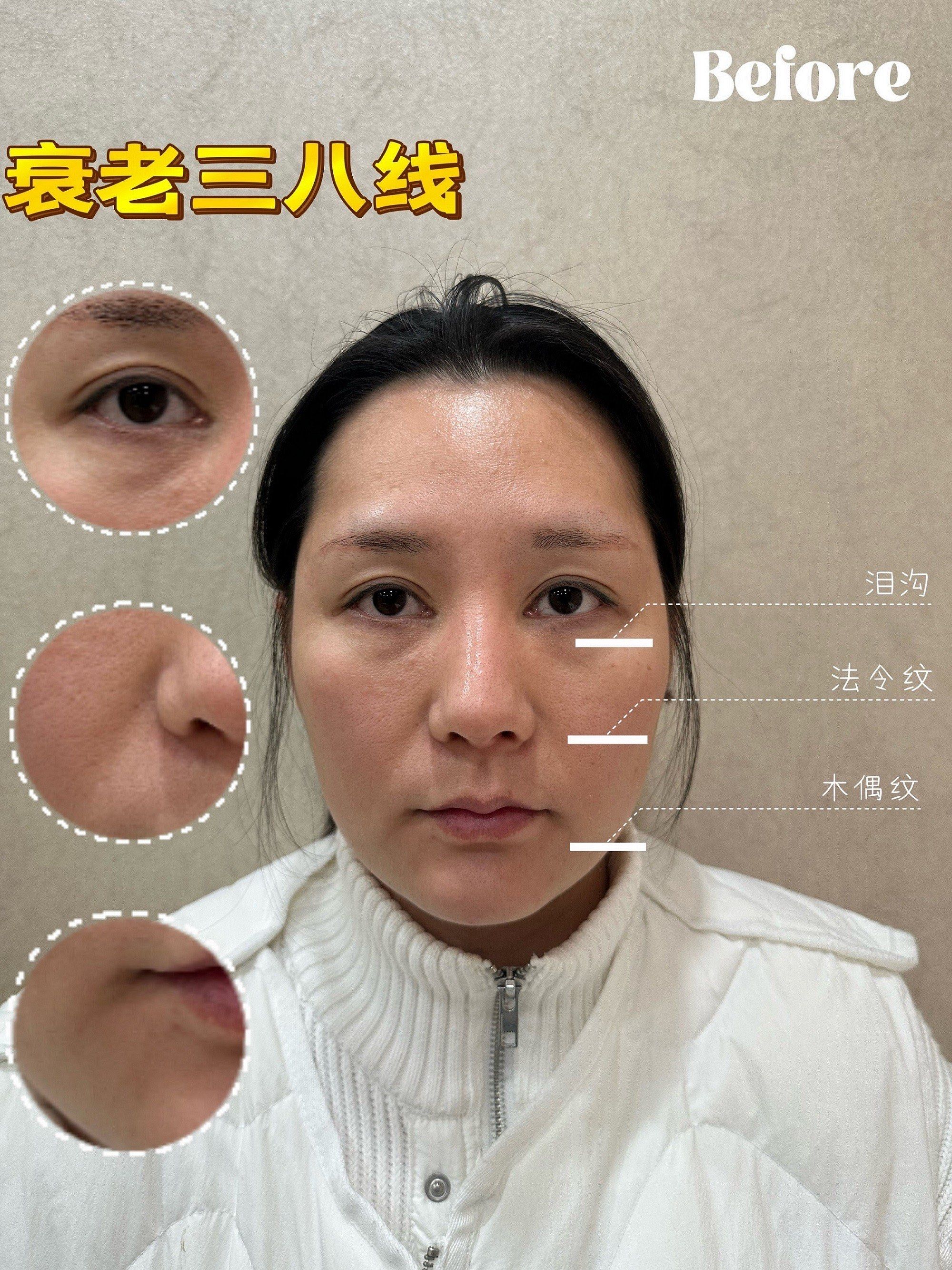 法令纹泪沟抗衰