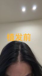 -碧莲盛·不剃发植发