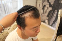 点击看大图 -大麦微针植发丨全国连锁