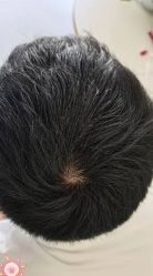 -大麦微针植发丨全国连锁