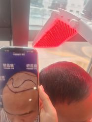 -碧莲盛·不剃发植发