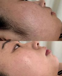 -薇兰专业脱毛连锁机构