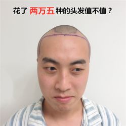 -碧莲盛·不剃发植发