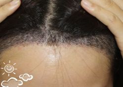 -大麦微针植发丨全国连锁