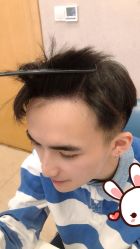 点击看大图 -大麦微针植发丨全国连锁