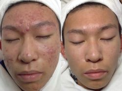 -美丽人生祛斑扁平疣汗管瘤中心
