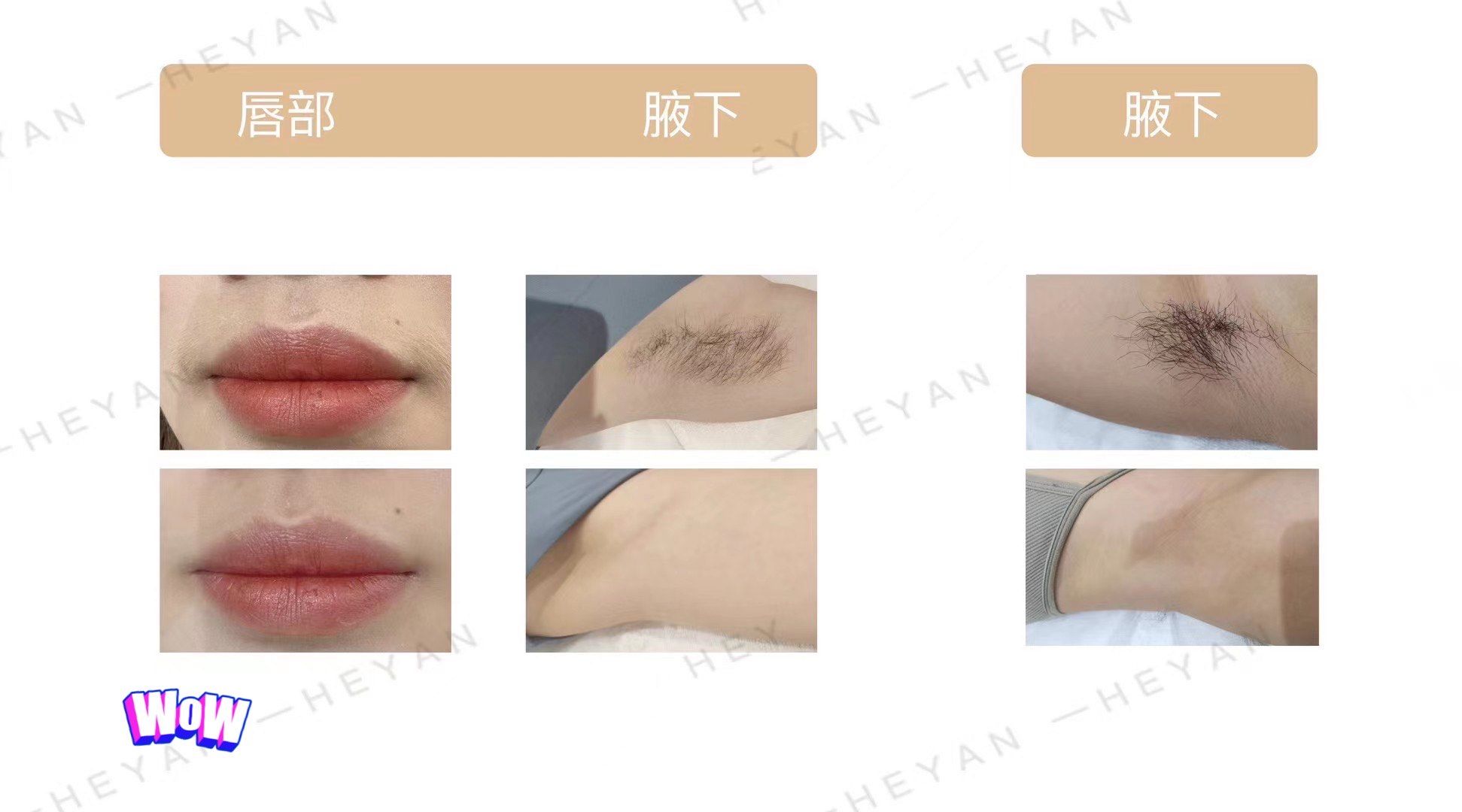 唇部/腋下/腋下脱毛对比照片