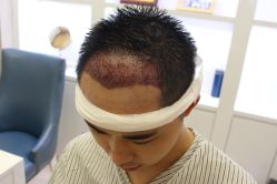 -大麦微针植发丨全国连锁