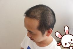 -大麦微针植发丨全国连锁