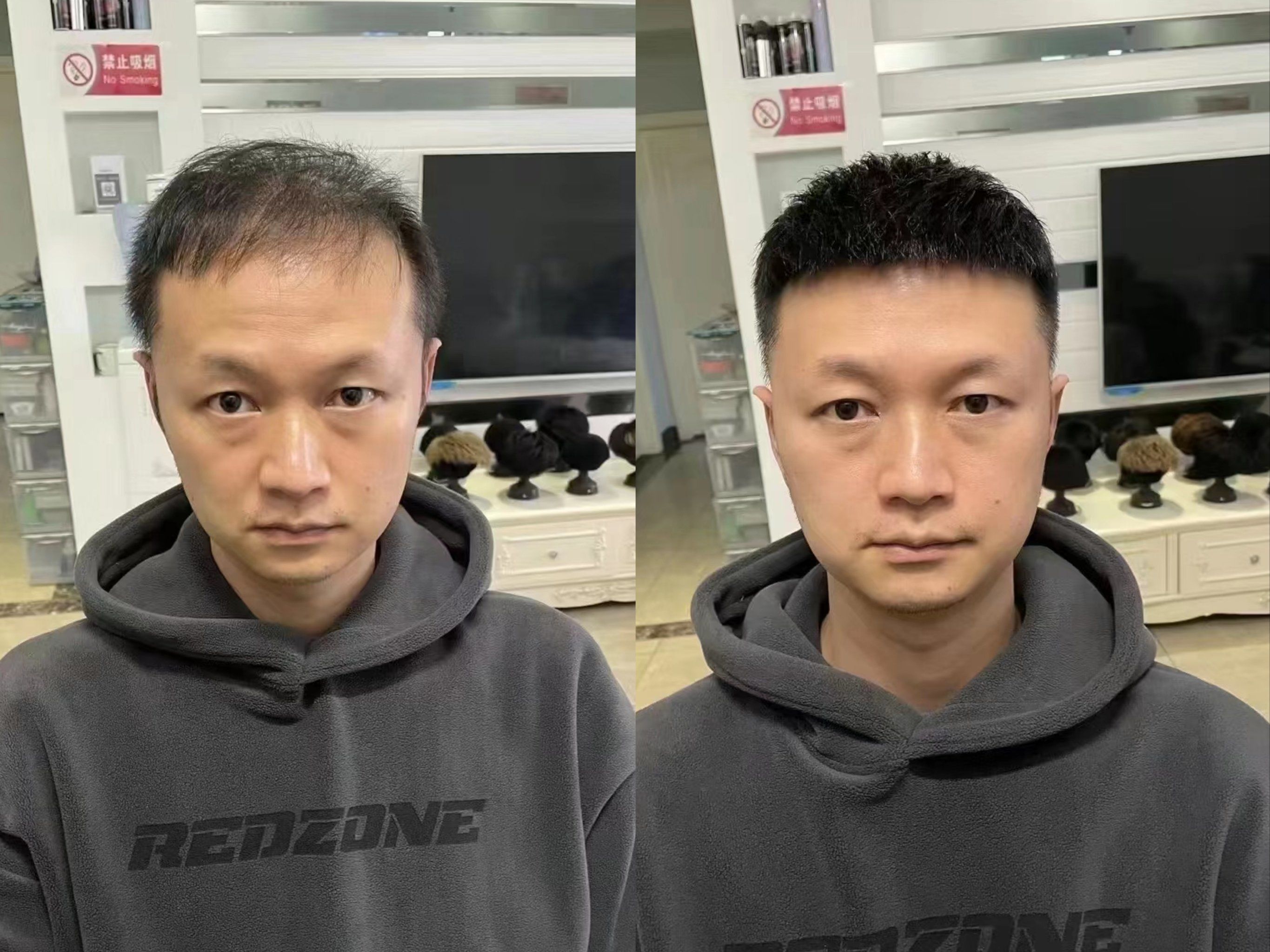 头发稀少的小哥哥们不用再犹豫啦