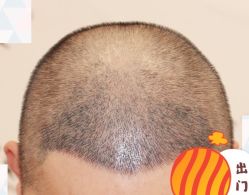 -大麦微针植发全国连锁