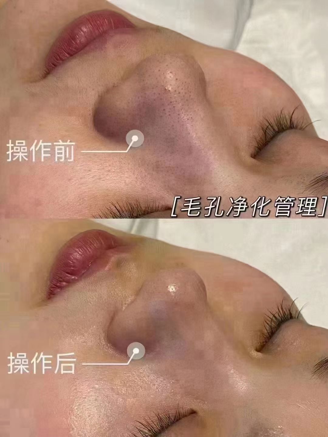 99元面部微雕1次    
99元腰