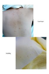 点击看大图 第一次治疗-金品苗方专业祛痘中心