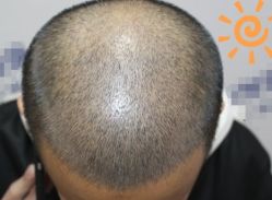 -大麦微针植发丨全国连锁