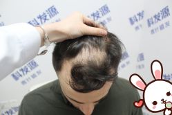 -大麦微针植发丨全国连锁
