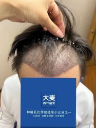-大麦微针植发全国连锁