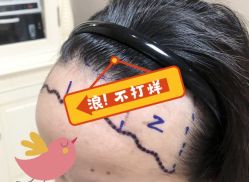 -大麦微针植发全国连锁