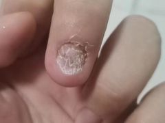 -Andrew指甲专科灰指甲·甲沟炎矫正·3D步态矫形鞋垫定制(浦三路店)