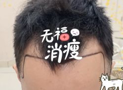 -大麦微针植发全国连锁