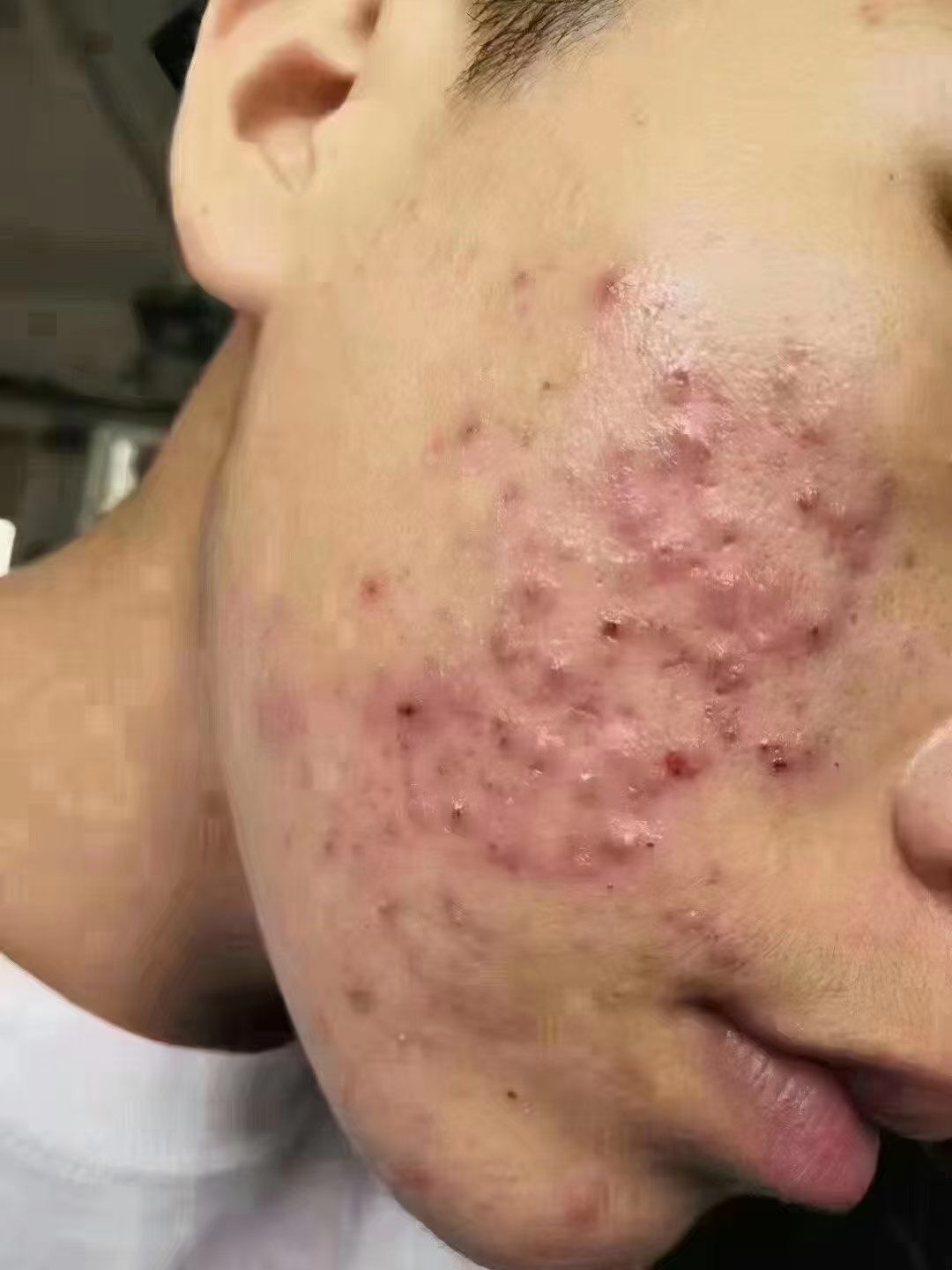 痘痘脸最怕三种处理方式
