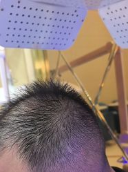 -碧莲盛·不剃发植发