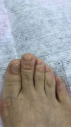 点击看大图 -德哥灰指甲脚气甲沟炎跖疣护理