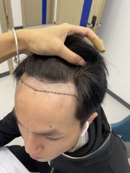 点击看大图 体验前-大麦微针植发全国连锁