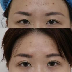 -广州健丽·去眼袋医疗美容机构
