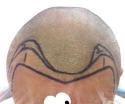 -大麦微针植发全国连锁