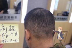 -大麦微针植发丨全国连锁