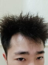 -碧莲盛·不剃发植发