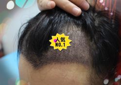 -大麦微针植发全国连锁