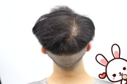 -大麦微针植发丨全国连锁