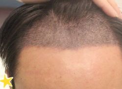 -大麦微针植发丨全国连锁