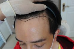 -大麦微针植发丨全国连锁