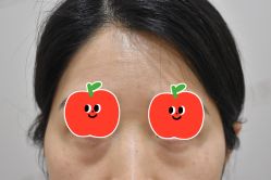 体验前-广州健丽·去眼袋医疗美容机构