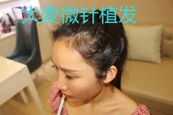 -大麦微针植发丨全国连锁