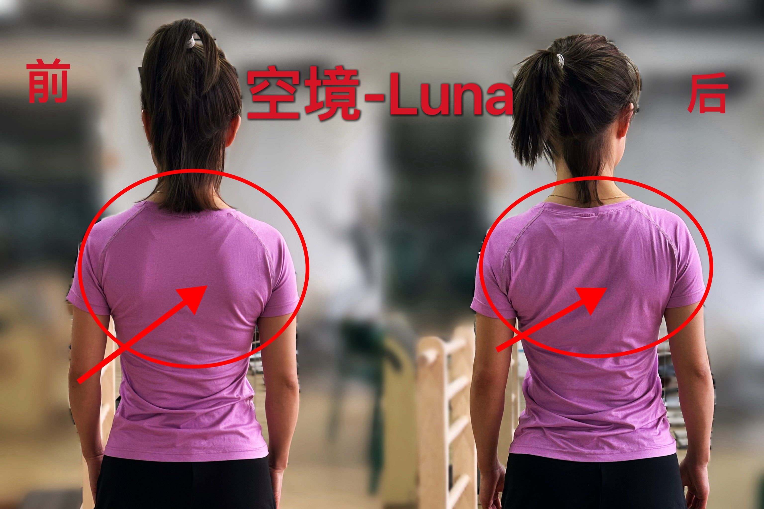 翼状肩胛调整前后对比图