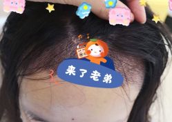 -大麦微针植发全国连锁