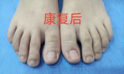-德哥灰指甲脚气甲沟炎跖疣护理
