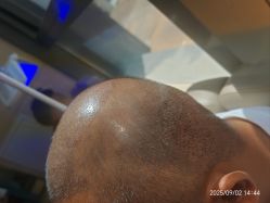 -碧莲盛·不剃发植发