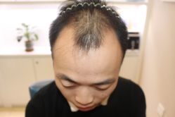 -大麦微针植发丨全国连锁