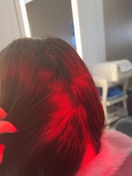 -大麦微针植发全国连锁