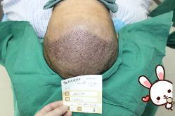 点击看大图 -大麦微针植发丨全国连锁