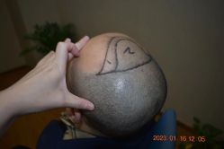 体验前-大麦微针植发全国连锁