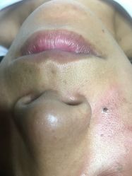 -痣清宫祛斑祛痣连锁店