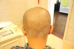 点击看大图 -大麦微针植发丨全国连锁